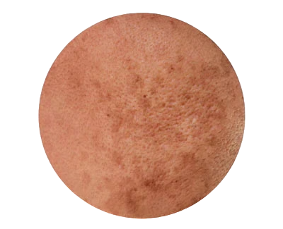 Fine Lines, Sun Damage & Enlarged Pores