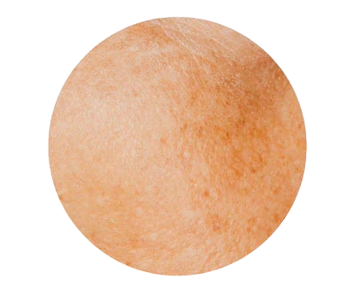 Acne Marks & Hyperpigmentation