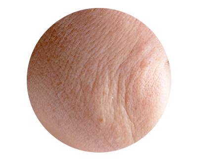 Fine Lines, Sun Damage & Enlarged Pores