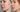 At Home Chemical Peel for Acne Scars: A Professional Guide to Deep Resurfacing - Skin Culture