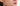 At Home Chemical Peel for Cystic Acne: The Guide to Deep Resurfacing - Skin Culture