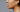 How to Get Rid of Acne Scars at Home: The Professional 6-Day Resurfacing Guide - Skin Culture