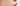 How to Get Rid of Deep Acne Scars: A Guide to Skin Resurfacing - Skin Culture