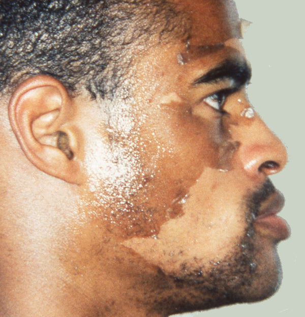 Visible peeling — the old skin layer shedding naturally