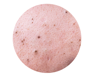 Blackheads