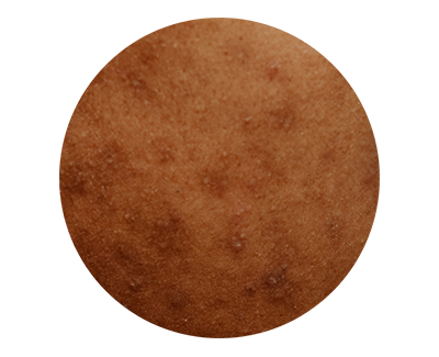 Hyperpigmentation