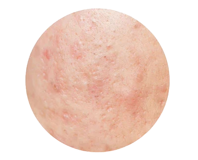 Acne Marks & Hyperpigmentation