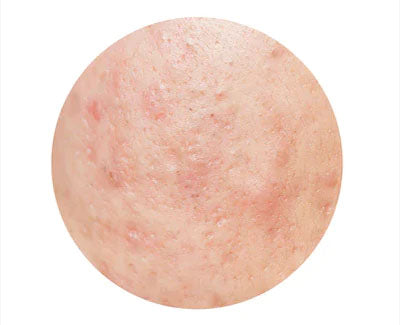 ACNE SCARS & ACNE MARKS