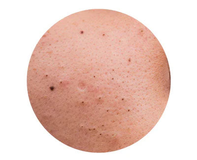 BLACKHEADS