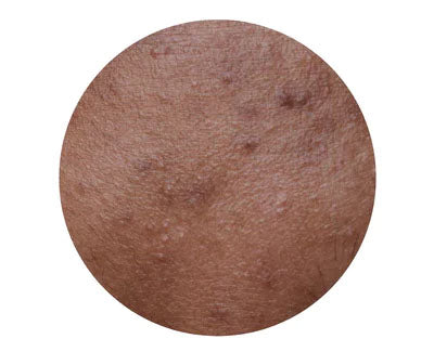 HYPERPIGMENTATION