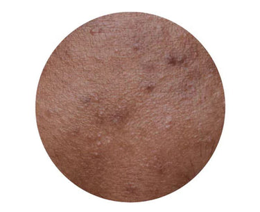 HYPERPIGMENTATION