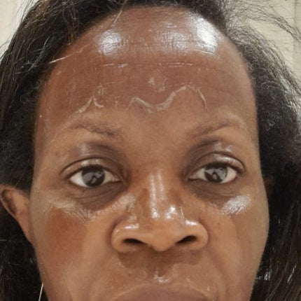 Natural skin shedding during the Normalizer phase