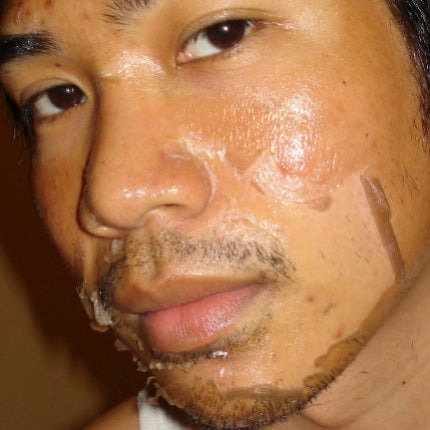 Day 6 — early stage of peeling, new skin emerging