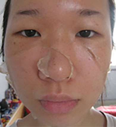 Skin peels away from the nose and cheeks