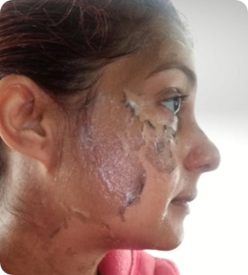 Noticeable peeling — a sign the treatment is working