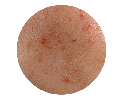 Spots & Pimples